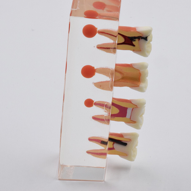 Dental Caries Disease M4018 Study Teaching Model Tooth Correcting Malocclusion