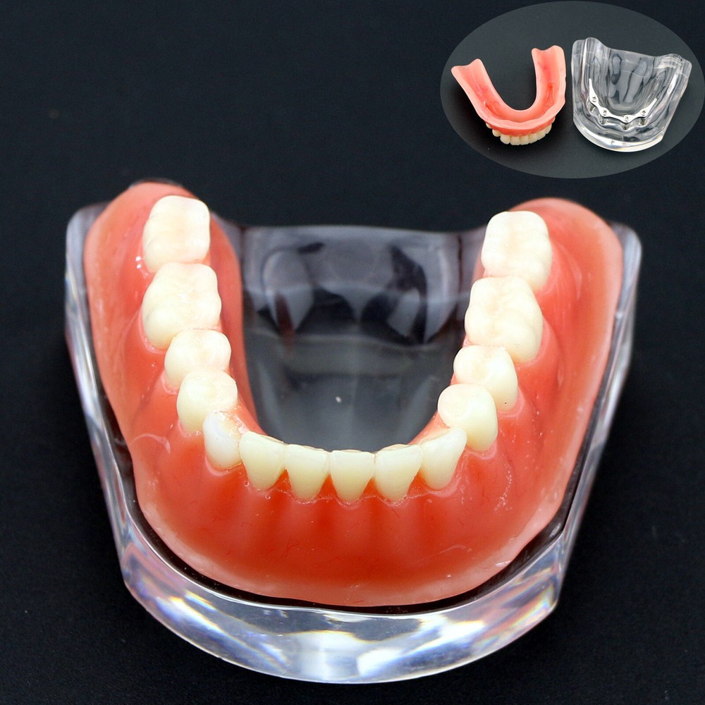 Dental Teeth Model Inferior Overdenture Precision 4 Implants Demo Silver Bar