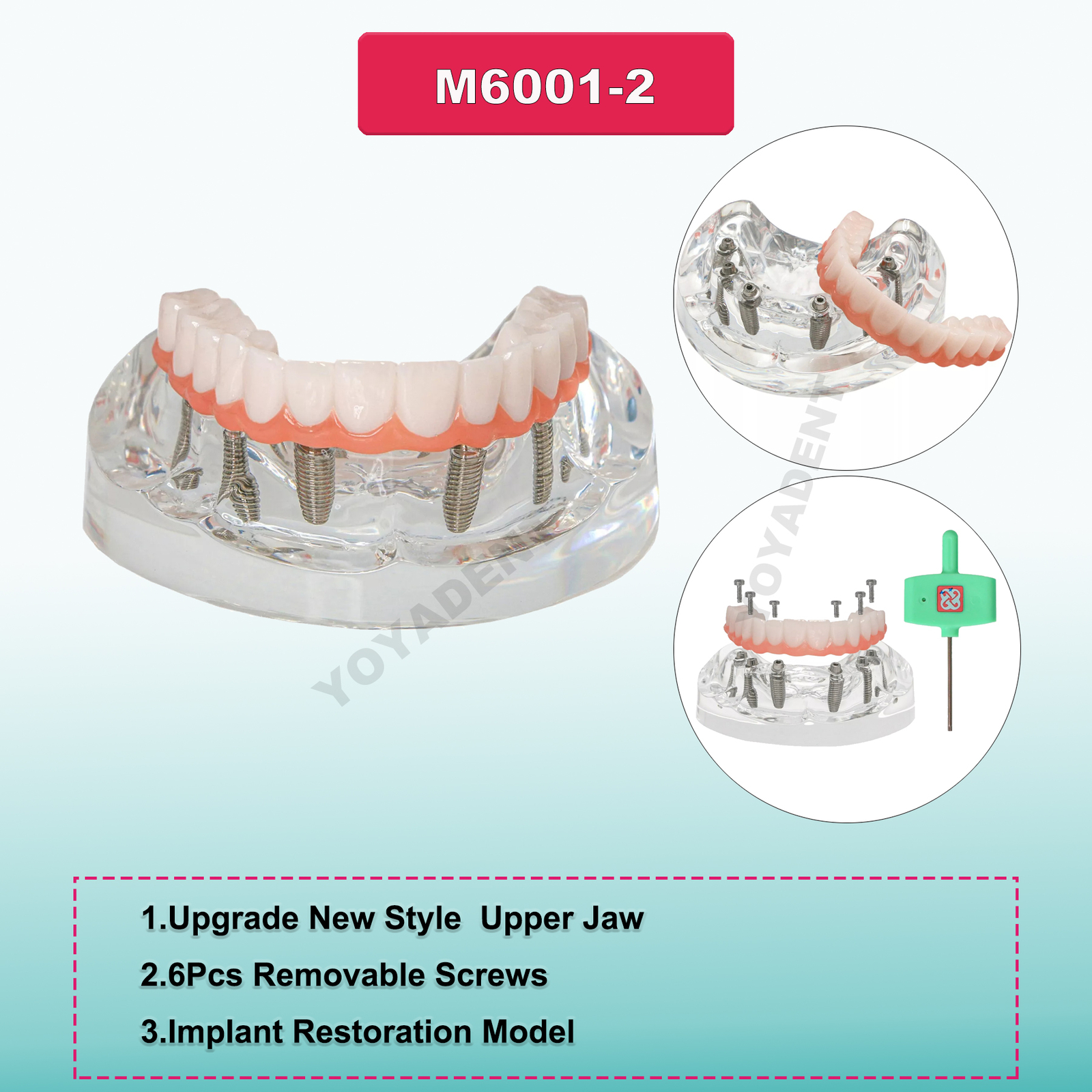 Dental Upper/Lower 4/6 Implants Demo Implant Teeth Model Restoration Overdenture
