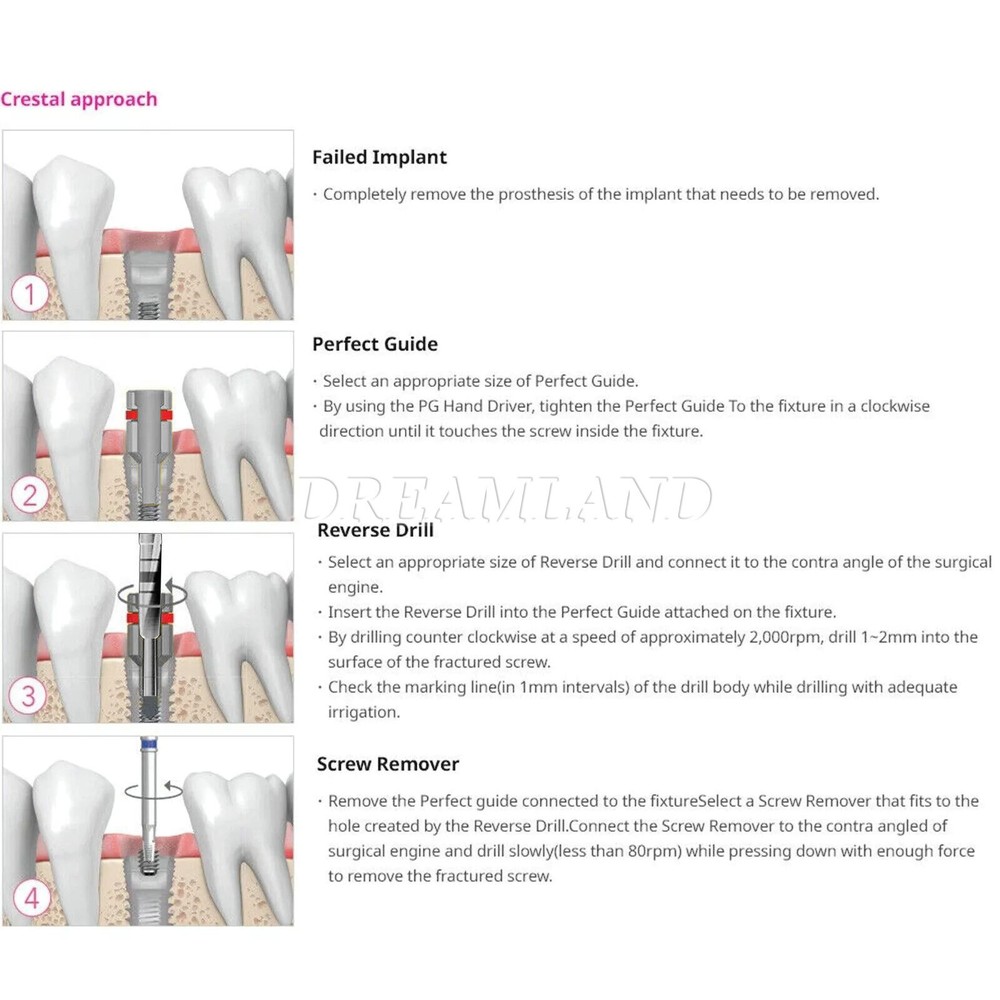 Dental Implant Broken Screw Remover Kit Reverse Drill Guide Driver SR Neobiotech