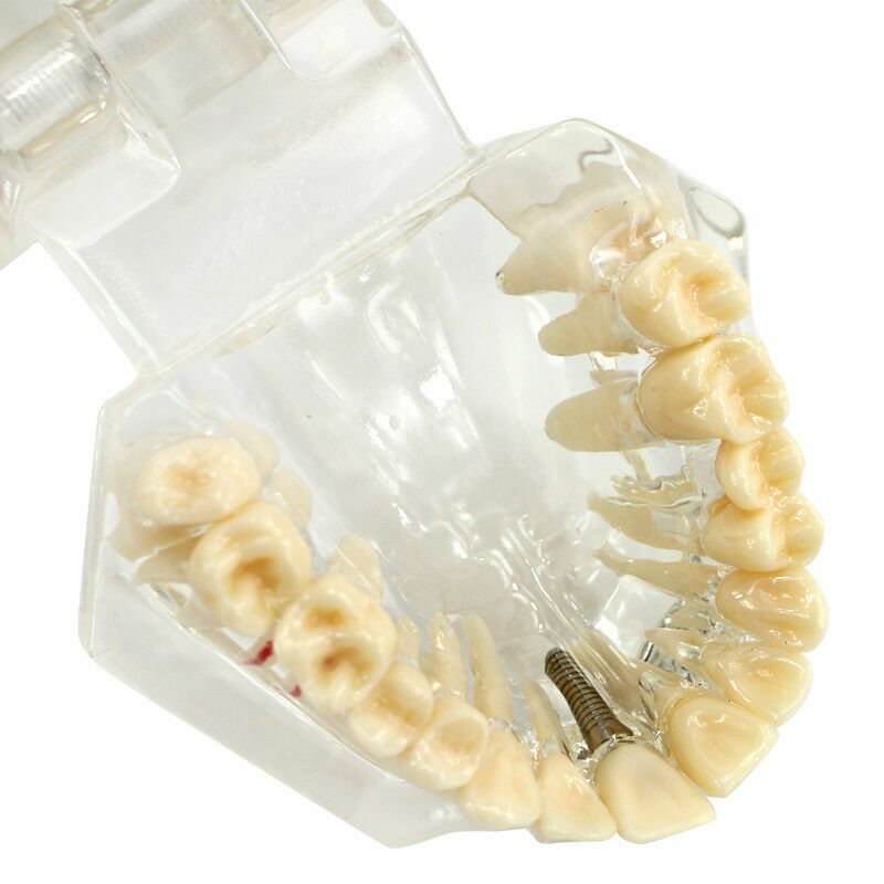 Dental Teeth Teaching Model Study Teach Implant Disease Analysis Removable Tooth
