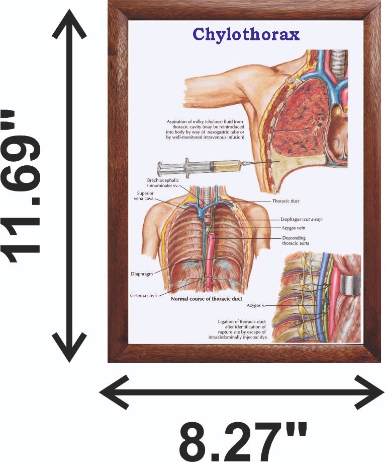 Chylothorax Chart 12x18 inches