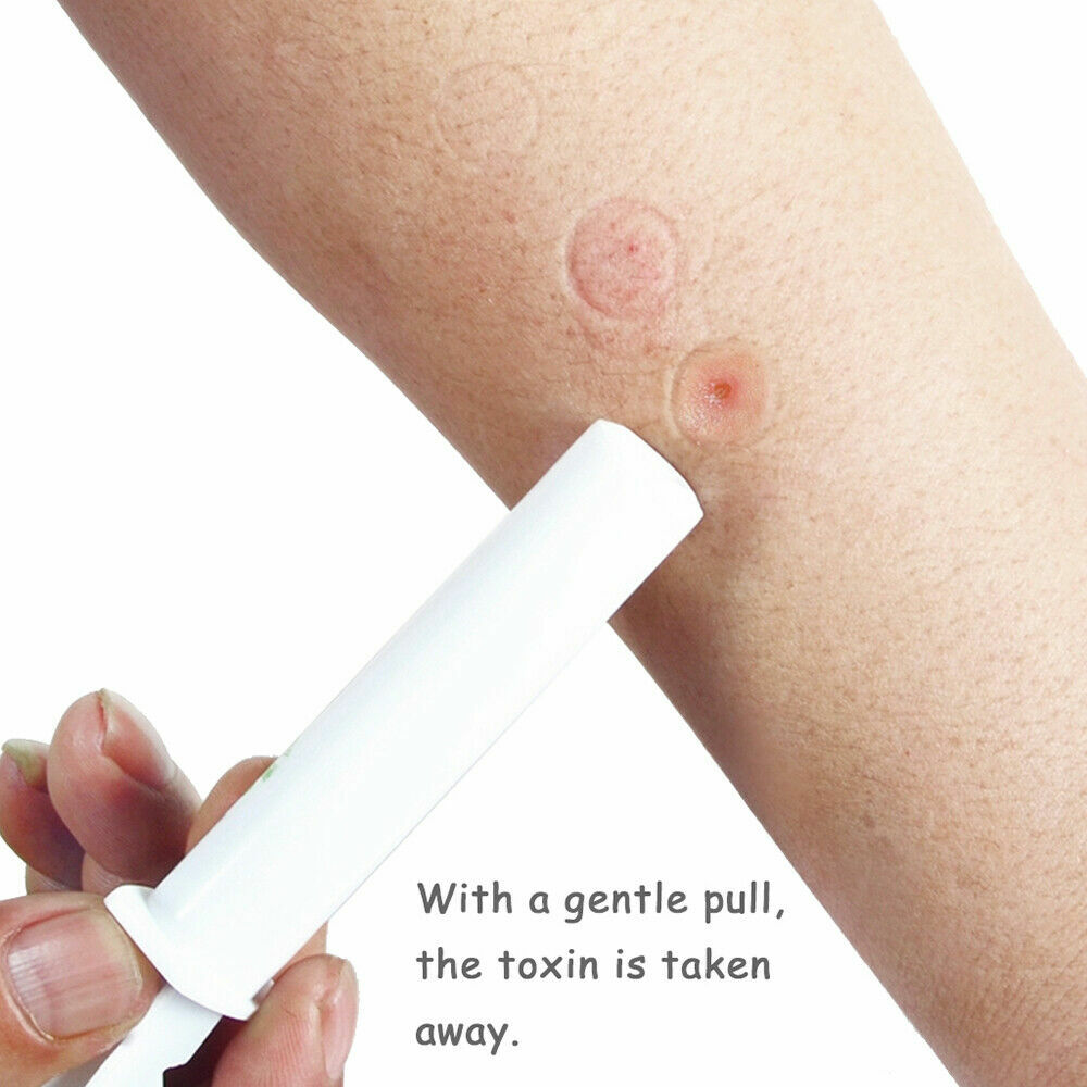 2Pack Extractor Pump Kit Will Suction Out Poison/Venom From Snake and Bug Bite