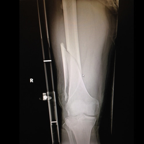 Slishman Traction Splint (STS) - Original Generation