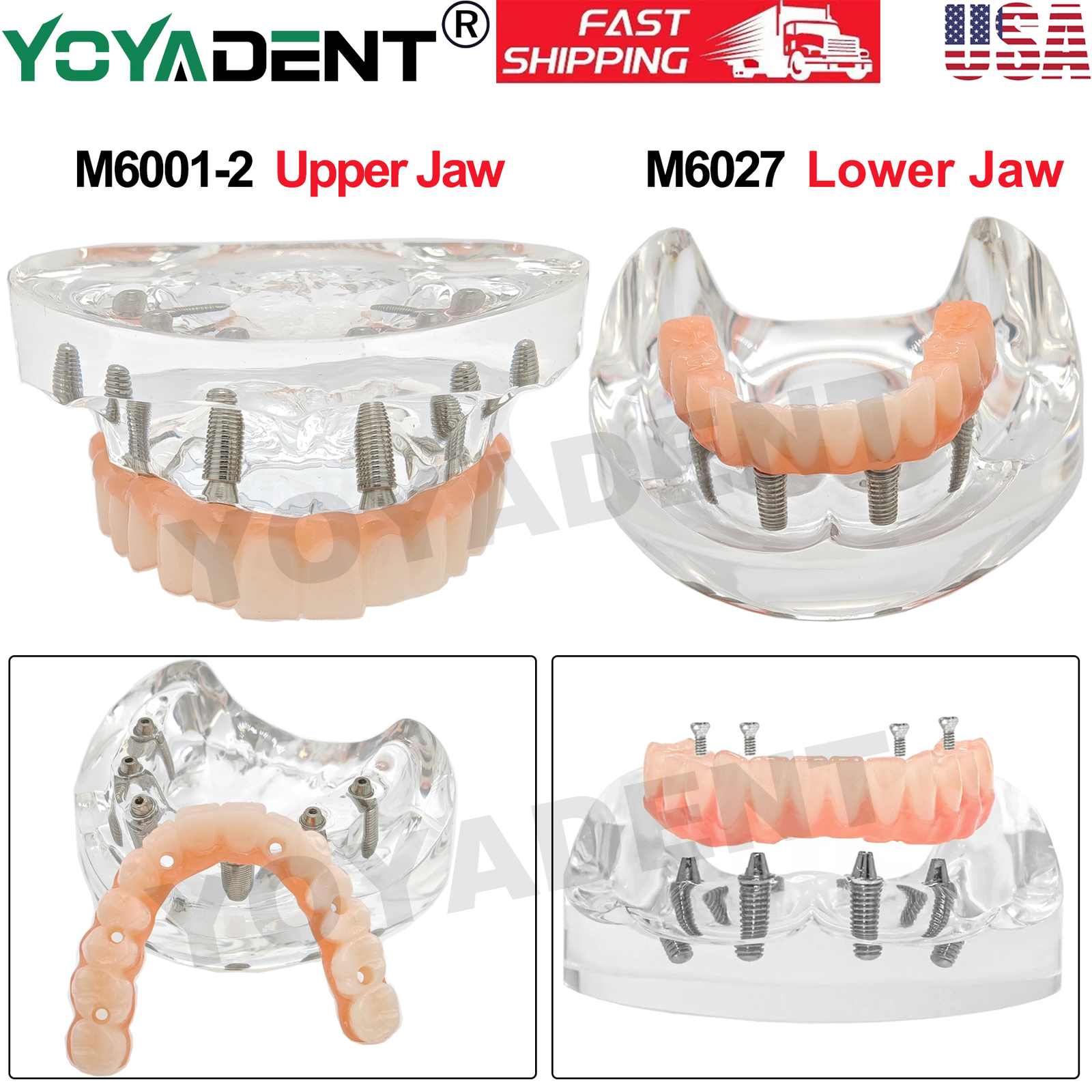 Dental Upper/Lower 4/6 Implants Demo Implant Teeth Model Restoration Overdenture
