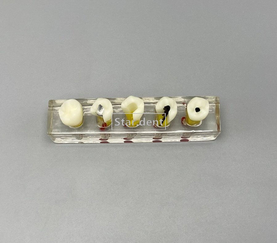Dental Caries Teeth Model Detachable Abutment Teaching Study Models 4 times