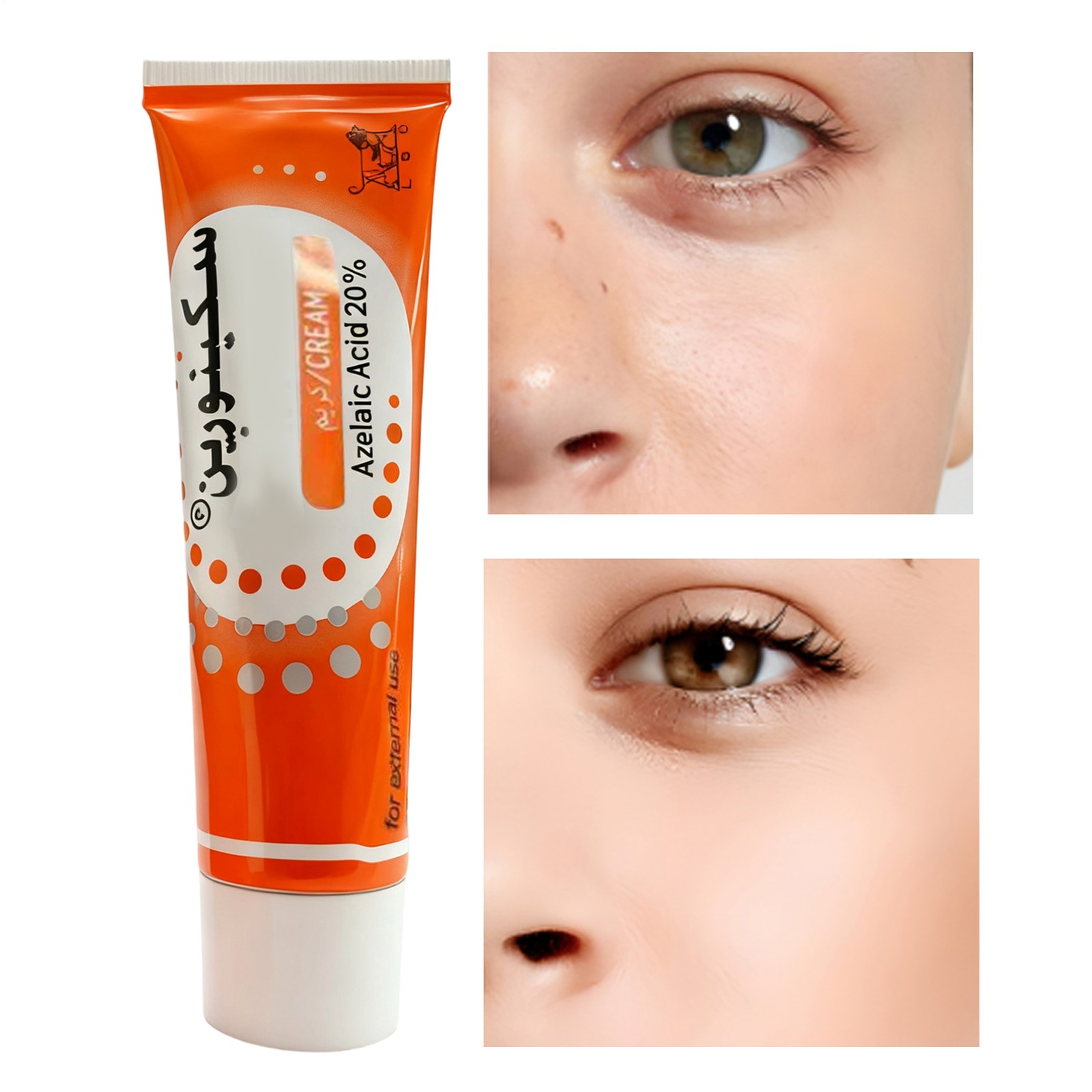 Skinoren Azelaic Acid 20% Anti AcneSolution Personal Skin Care