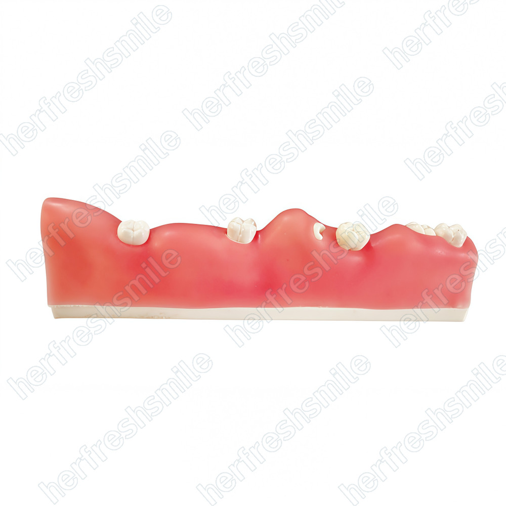 Dental Impacted Tooth Model Wisdom Unerupted Tooth Extraction Practice Training