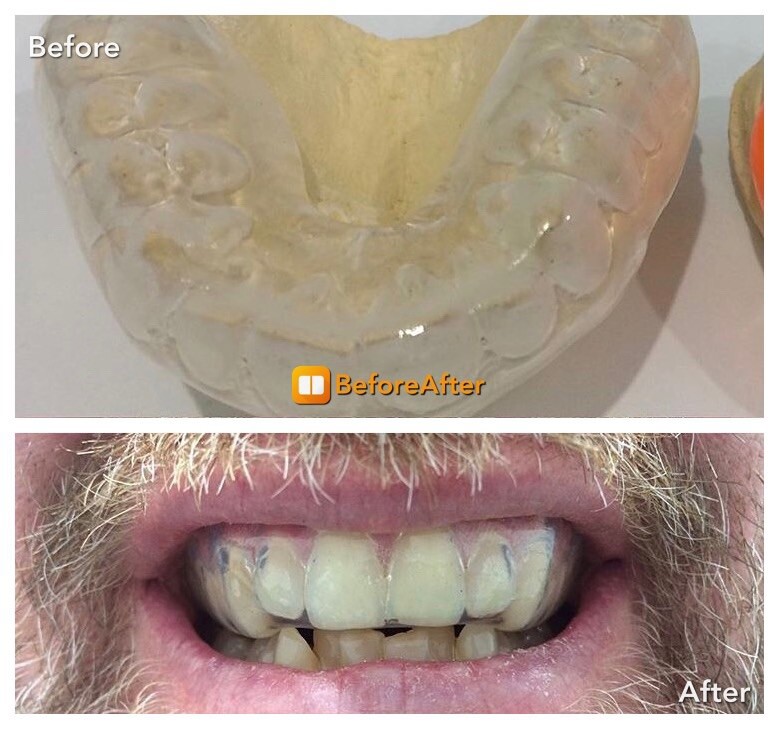 Mouth Guard Custom Made