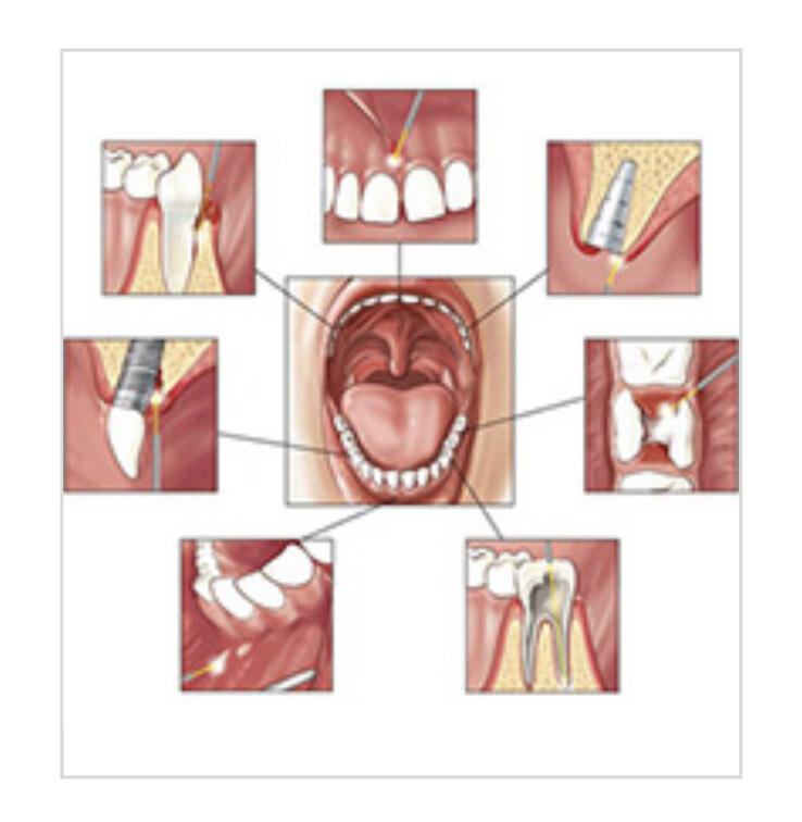 Medical Lab laser Diode soft tissue laser