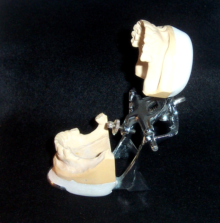 Overbite - Vintage Dental Articulated Model Teeth