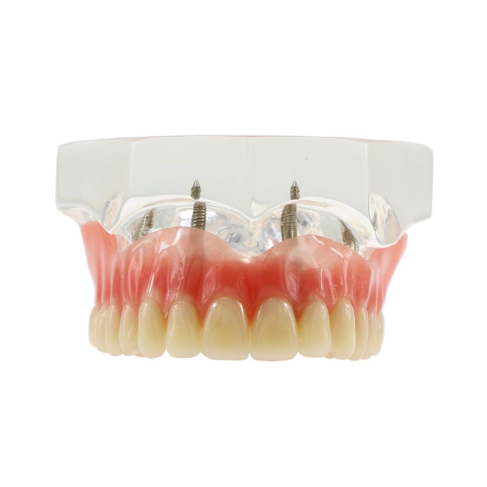 Dental Upper Implants Model Overdenture with 4 Superior Teeth Demo Transparen...