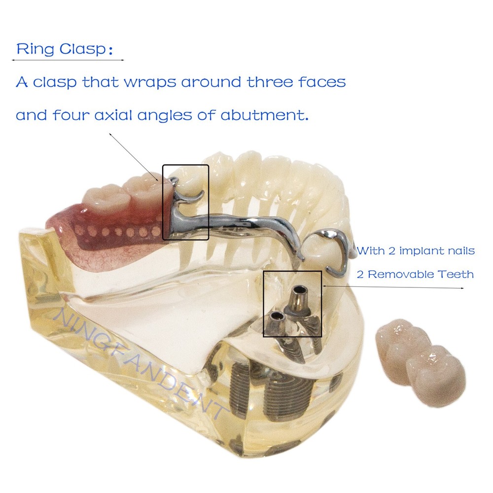 Dental Typodont partial denture Model RPD Demo Retainer WIth 2 Implants