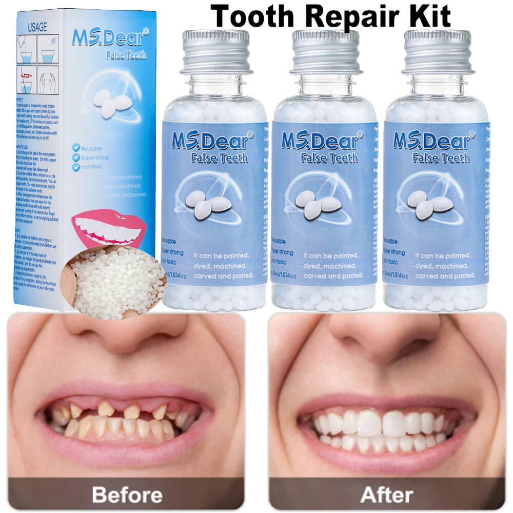 3X Tooth Repair Kit - Temporary Teeth Replacement Kit for Missing & Broken Teeth