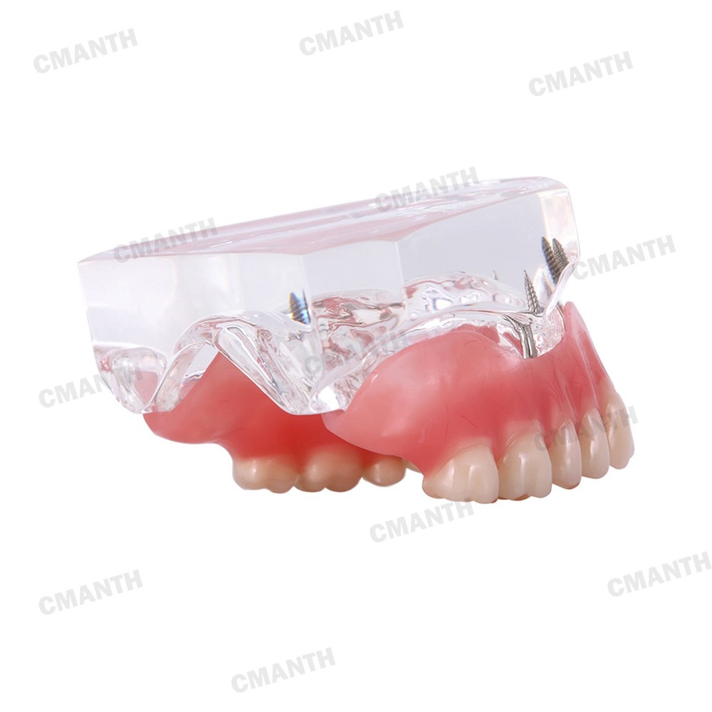 Dental Implant Teeth Model Overdenture Restoration with Upper Implants Demo