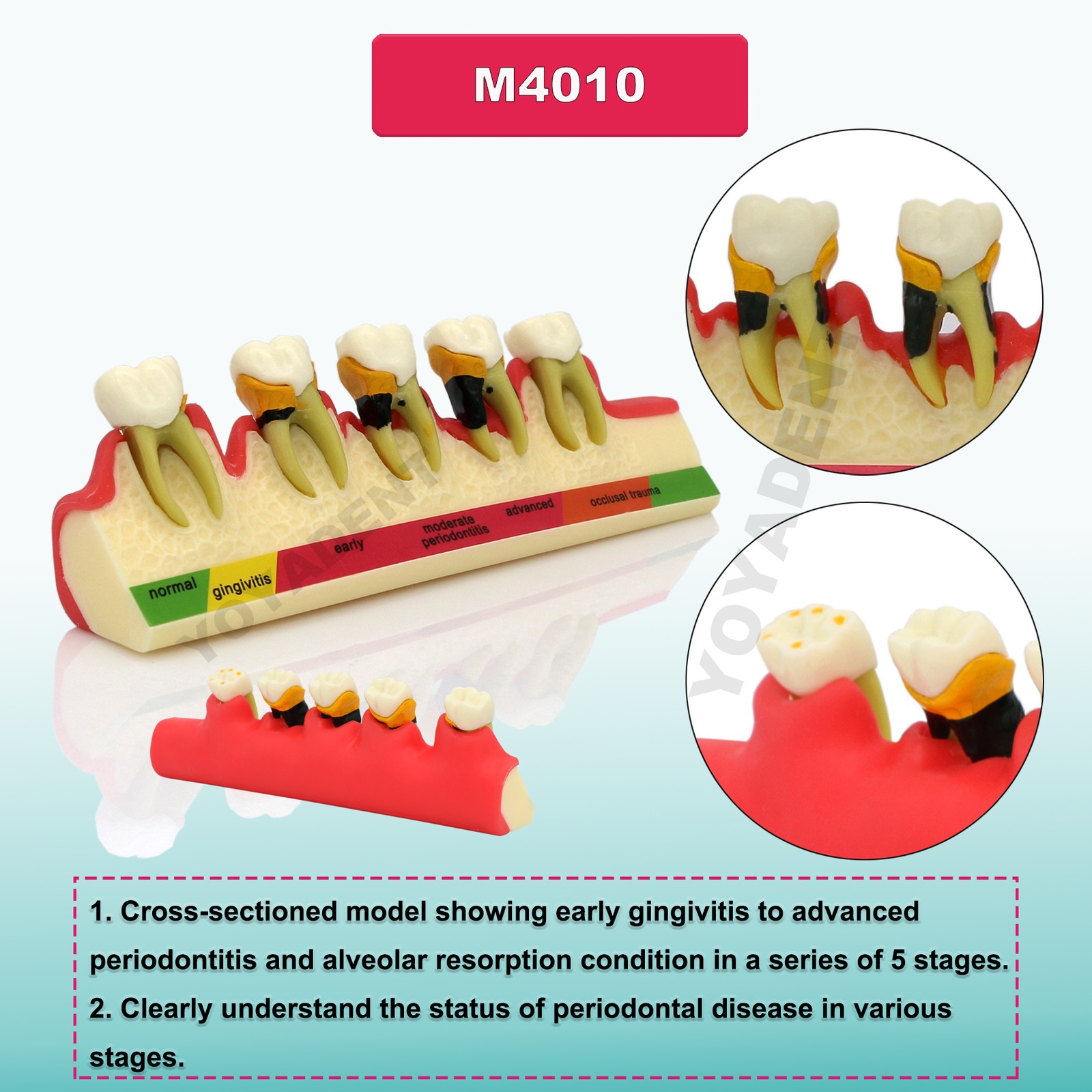 US Dental Teeth Model Periodontal Disease Assort Model 4 5-Stage Endodontic Demo