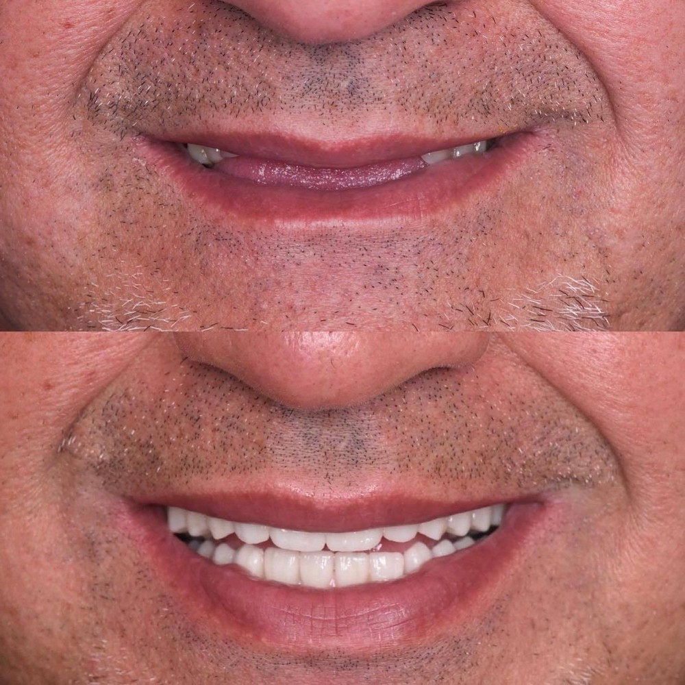 DLP SLA LCD 3d printer temporary teeth resin ..