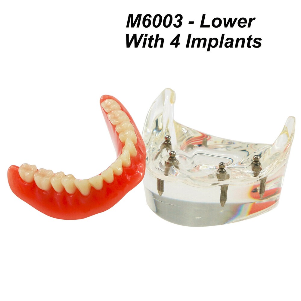Dental Ortho Teeth Model Implants Practice Teaching Restortion Brushing Model