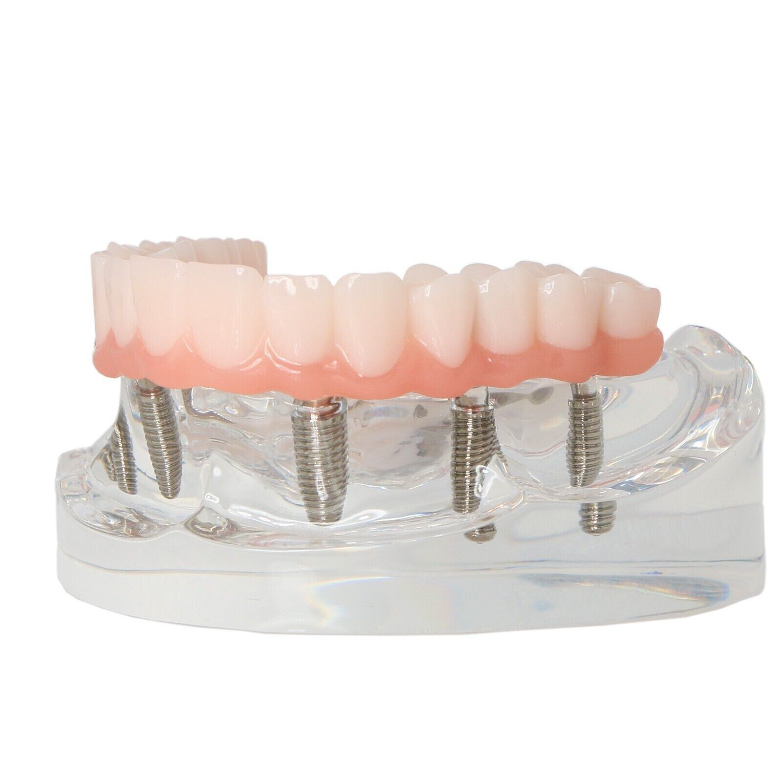 Dental All-On-6 Overdenture Implant Model Demo Upper Jaw 6 Screws Clear M6001-2