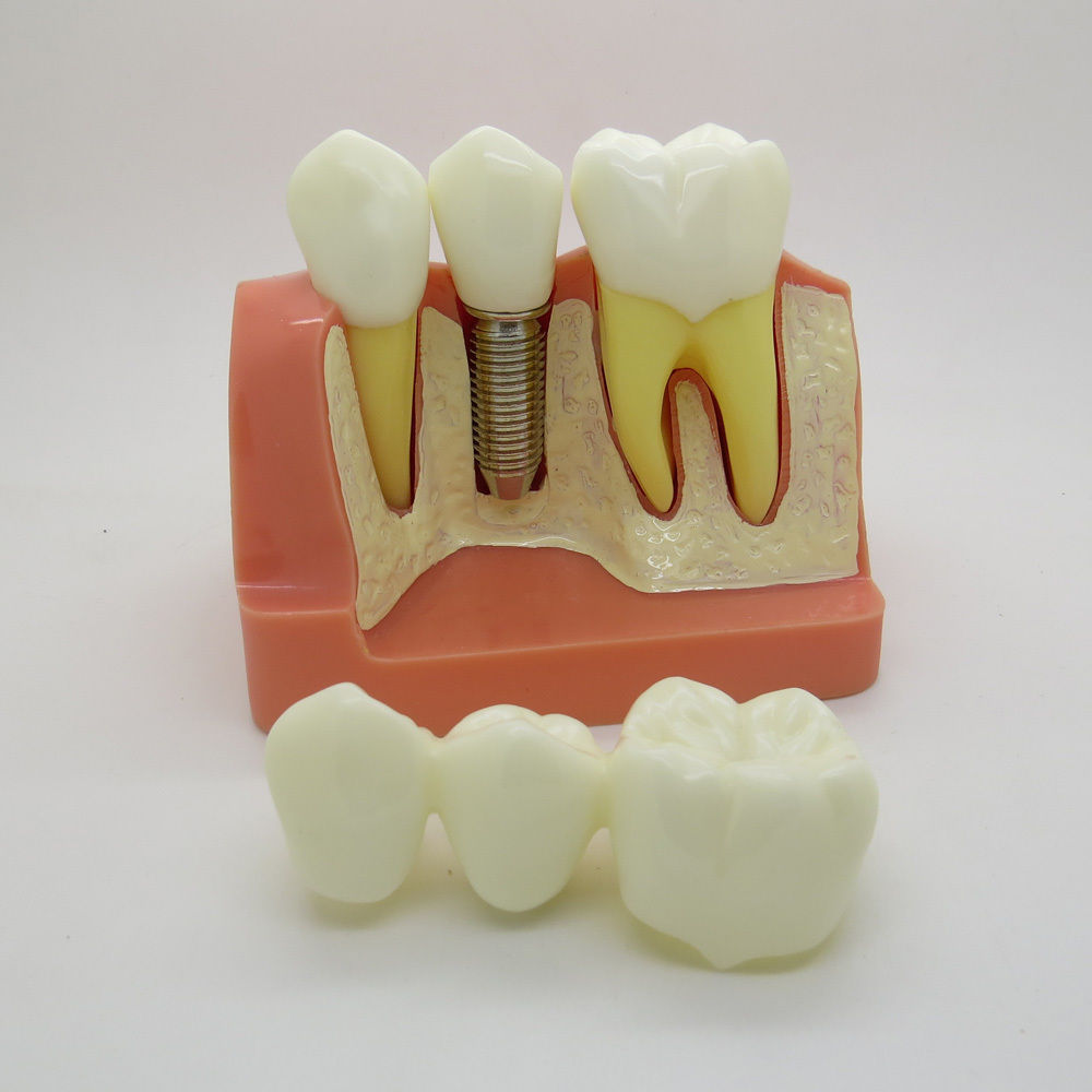 New Implant Analysis Dental Crown Bridge Demonstration Teeth Model Study Model