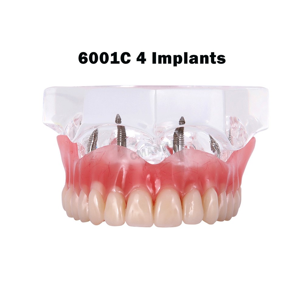 US Dental Model Removable Overdenture Teeth Upper/Lower Jaw 4 Implants Model