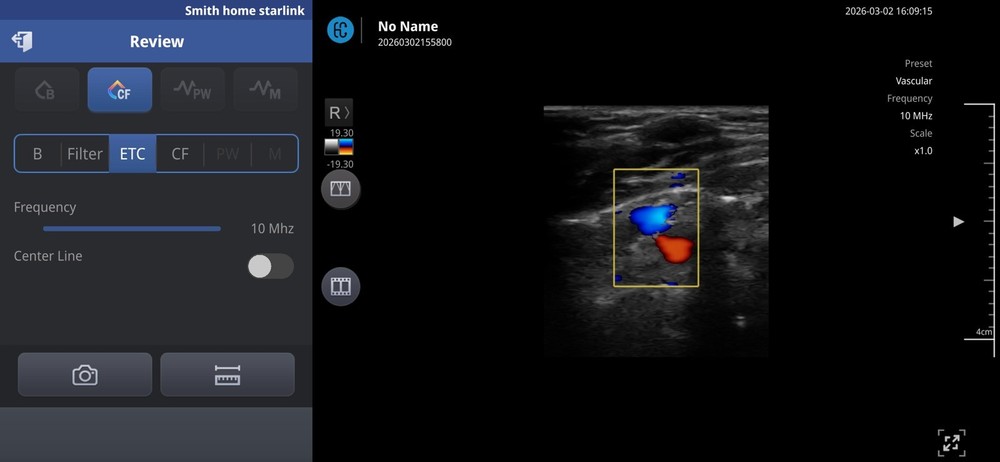 SONON 300L Linear Array Wireless Ultrasound Probe Device