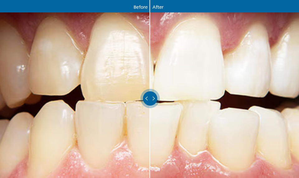 Zoom! WhiteSpeed Chairside Kit - Office Type Teeth Whitening System Two Patient