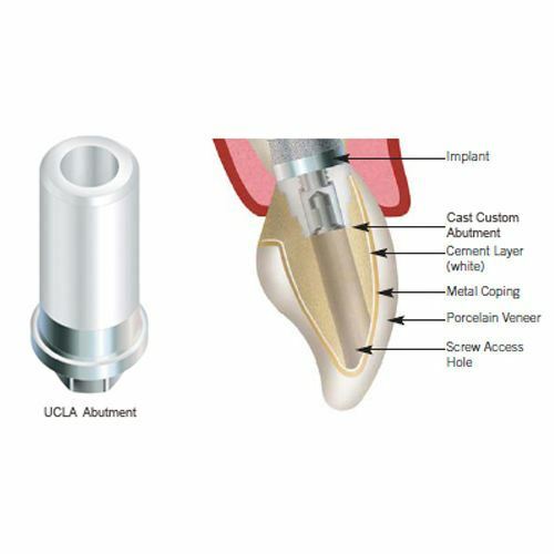 2X Dental UCLA Plastic Castable Abutment Titanium Base Int Hex screws Casting