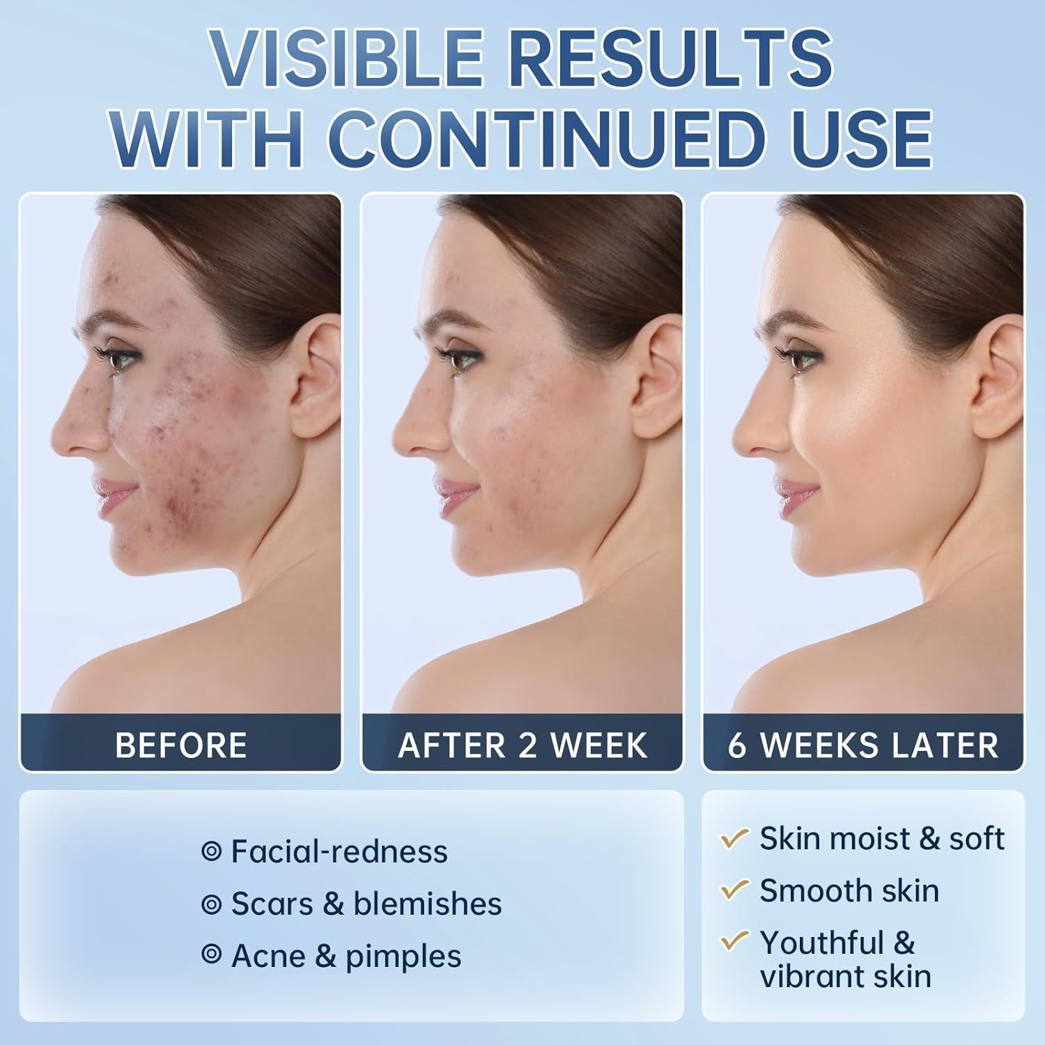 Azelaic Acid 14% Acne Cream for Redness Relief, Dark Spots, Facial Serum with Ni