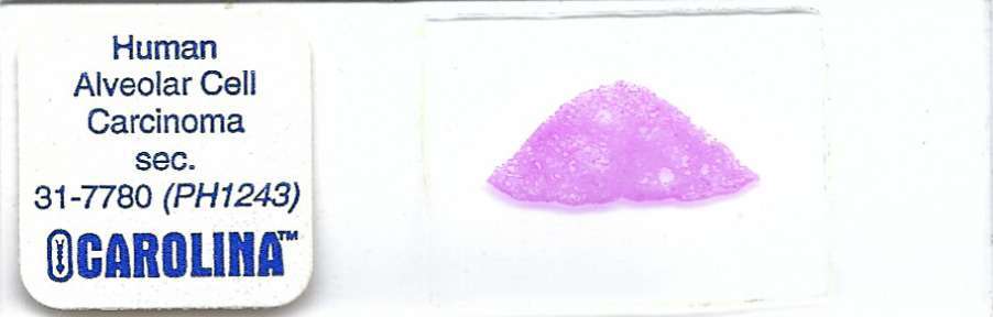 Human Alveolar Cell Carcinoma  Pathology Microscope Slide