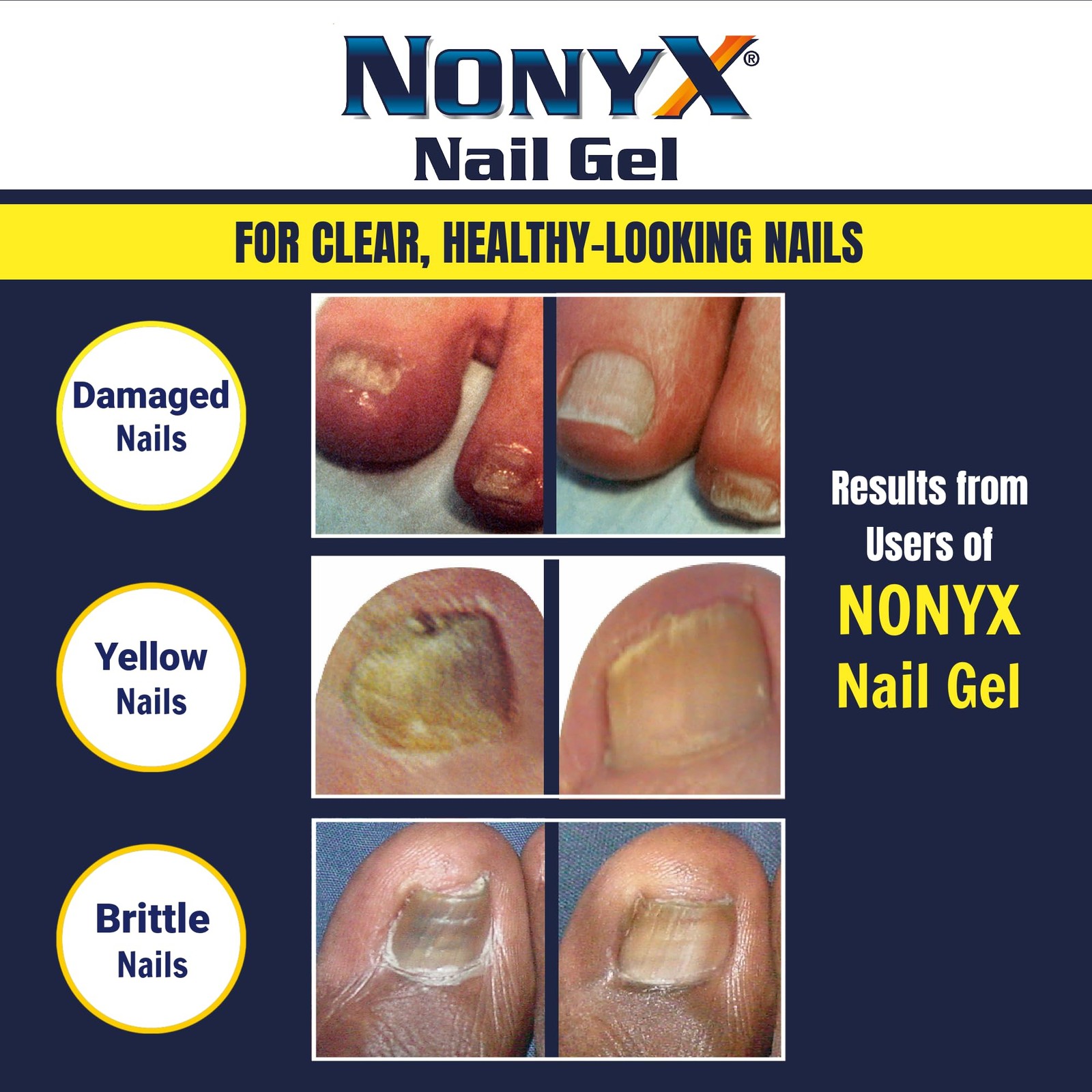 NONYX Fungal Nail Clarifying Gel - Discolored, Thick, Brittle Nails