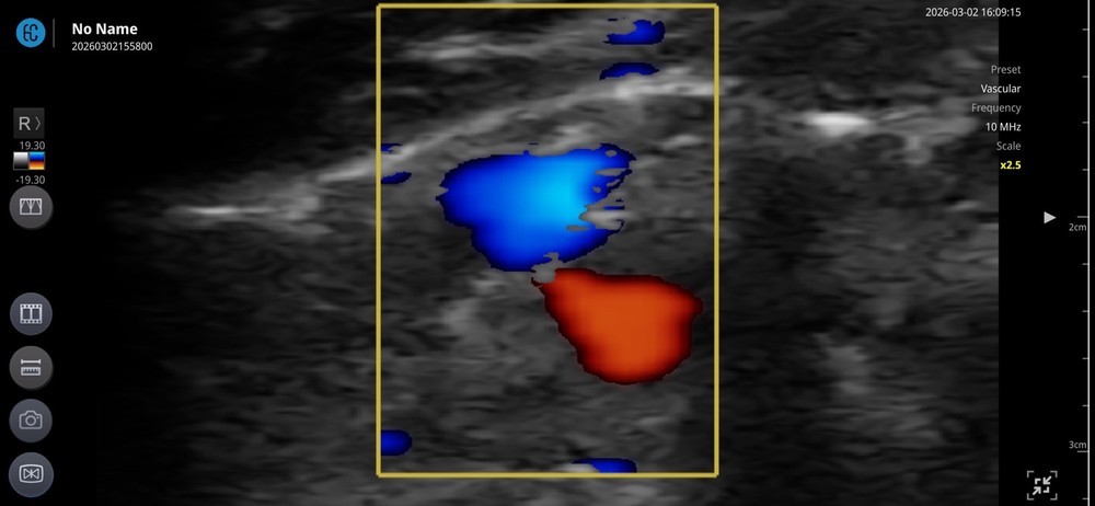 SONON 300L Linear Array Wireless Ultrasound Probe Device