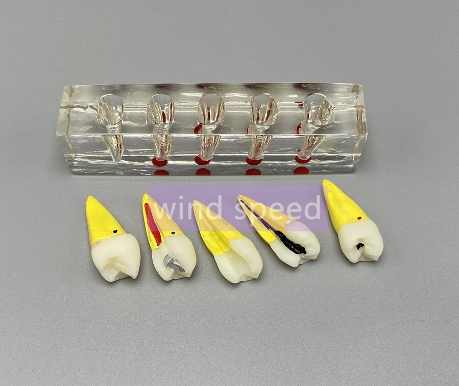 Dental Study Model Pulp Disease root canal curing Clinical Demonstration Analysi