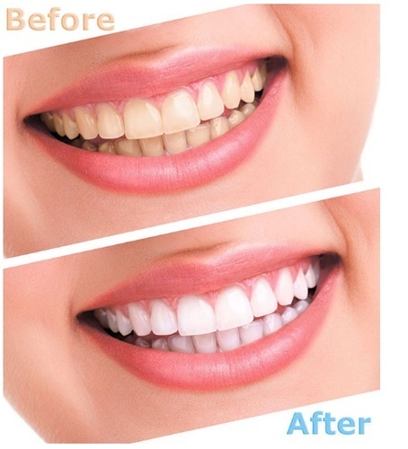 Advanced Teeth Whitening Strips (4 Strips) 2 Upper and 2 Lower~Hydrogen Peroxide
