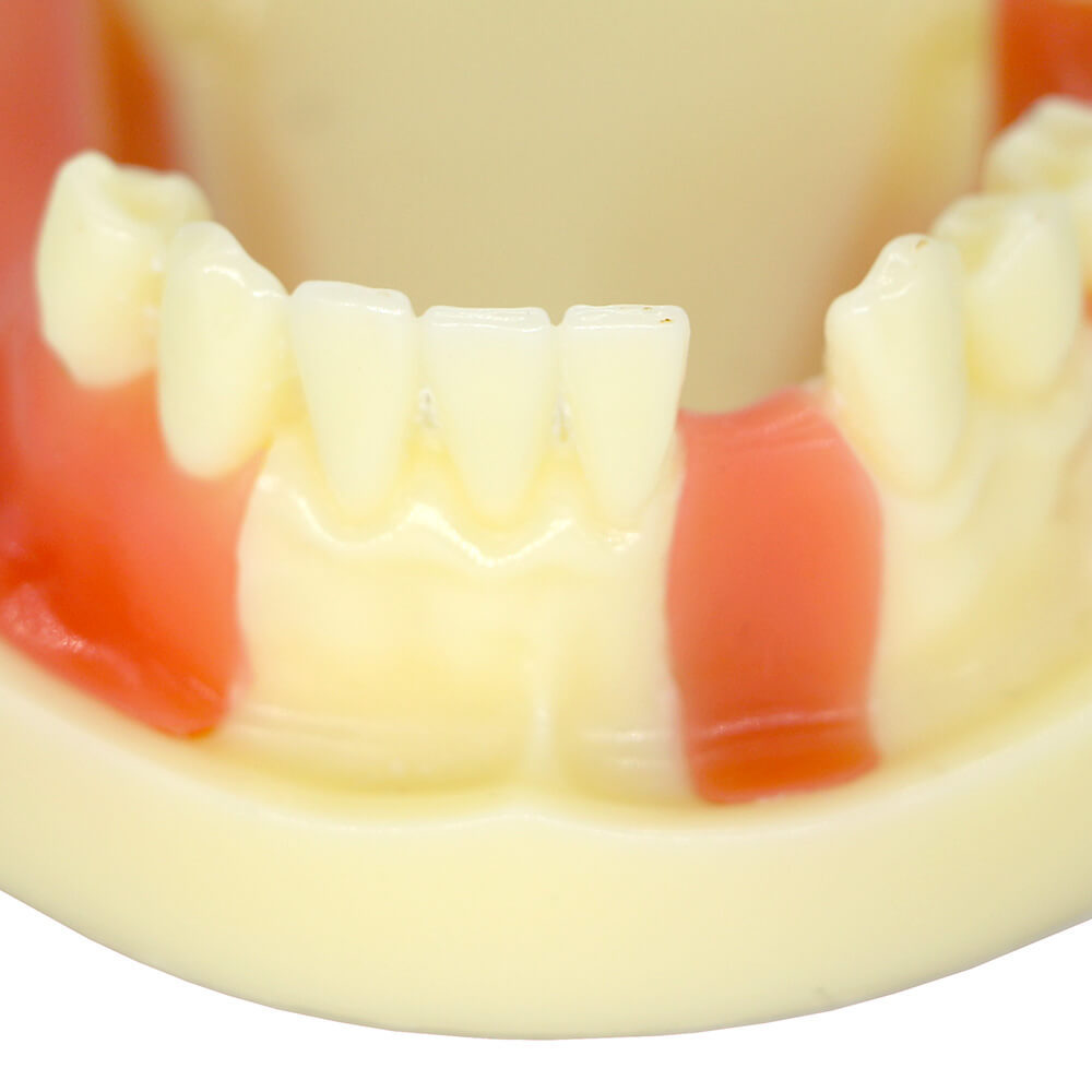 Dental Implant Training Model with Missing Teeth & Bone Loss Simulation