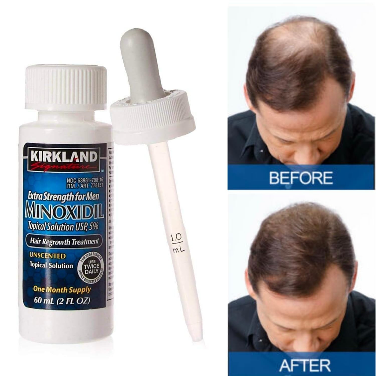 Kirkland Minoxidil 5% Extra Strength Mens 6 Month Bottles Hair Regrowth Solution