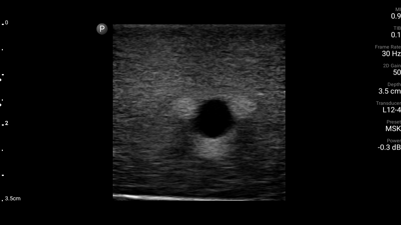 ultrasound phantom nerve bundle model