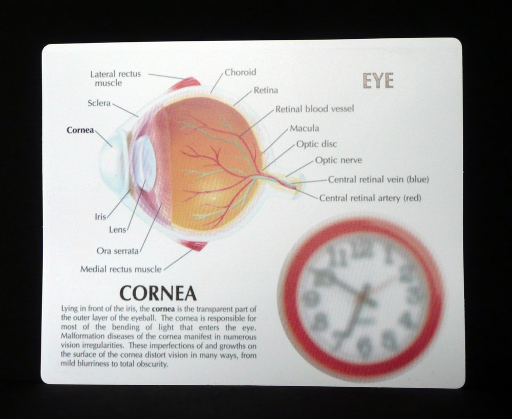 Anatomical Human Corneal Disease Model