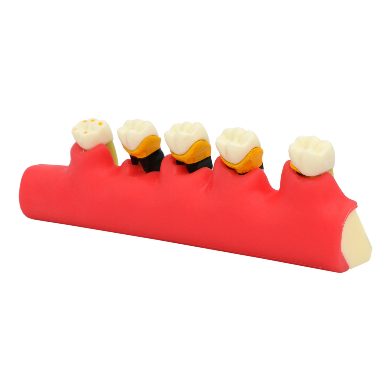 Dental Teeth Model Pathological Typodont Periodontics Endo Disease Assort Demo