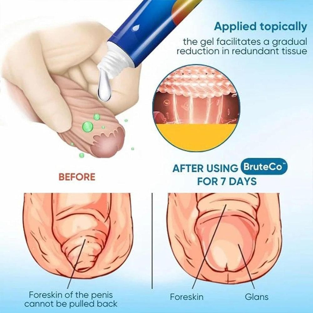 Prepuce Corrector Gel, Professional Redundant Prepuce Gel Corrector