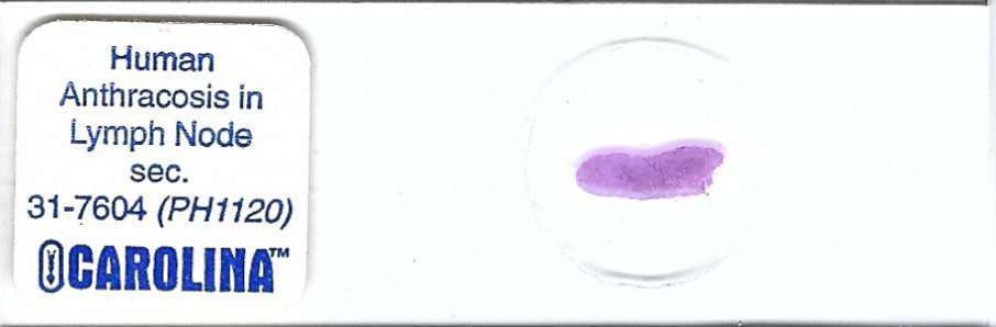 Human Anthracosis in Lymph Node Pathology Microscope Slide
