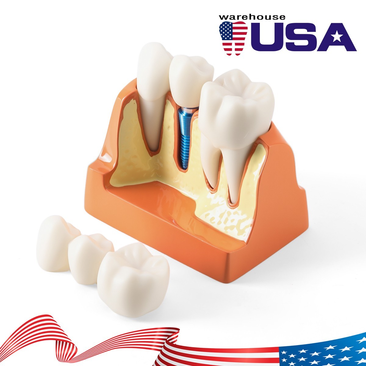 Dental 4 Times Teeth Model Implant Analysis Crown Bridge Demonstration Removable