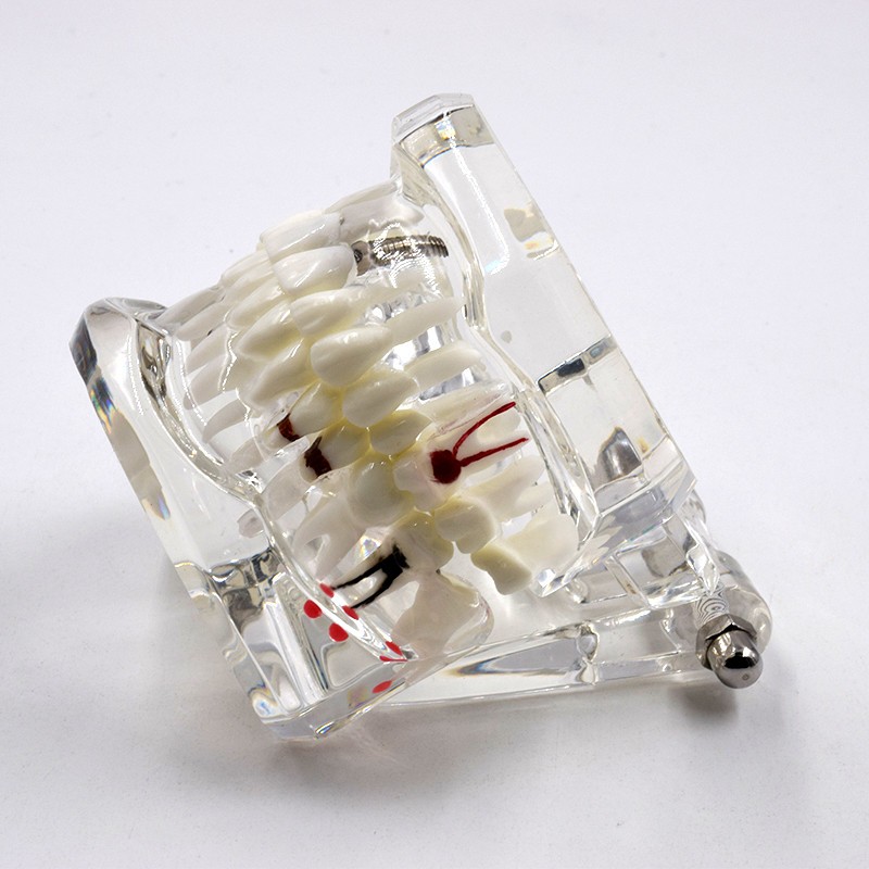 Dental Removable Restoration &Implant Pathological Disease Teeth Study Model