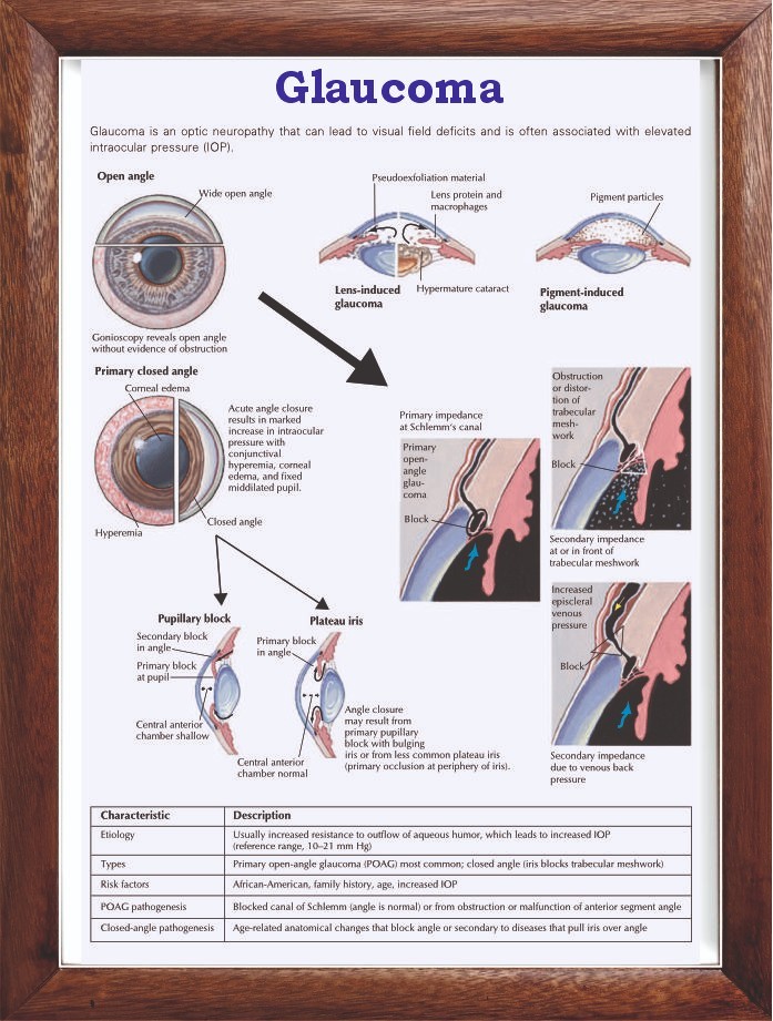 Glaucoma Chart 12x18 inches