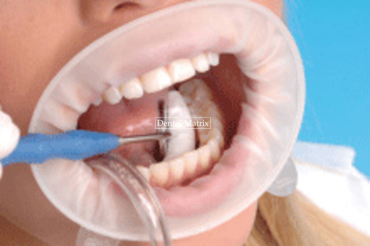 Ivoclar Vivadent Optragate 3D Lip Cheek Retractor Dental Mouth Opener Adult Kid