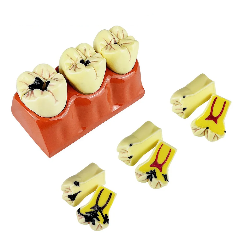 Dental 4 Times Caries Evolution Model Tooth Decay Comparsion Demonstration Model