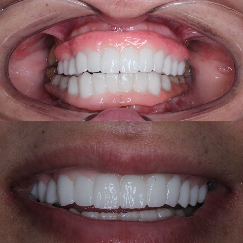 DLP SLA LCD 3d printer temporary teeth resin ..