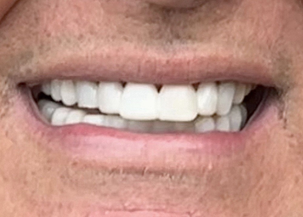 Custom Upper or Lower Cosmetic Click on Veneer