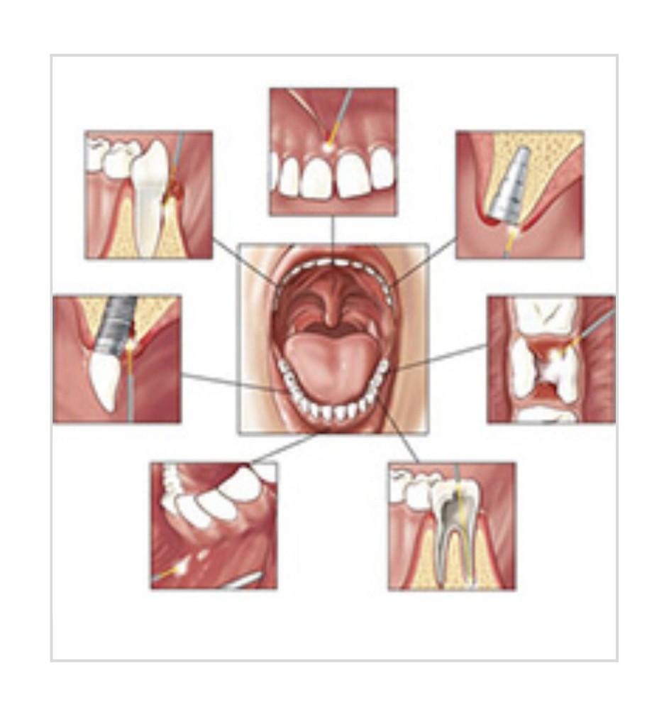 Dental Laser AMD Picasso Lite