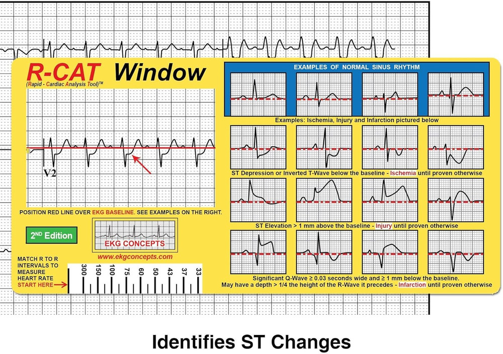 EKG Window: Second Edition